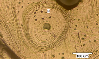 Micrograph of a pediatric OI cortical bone specimen